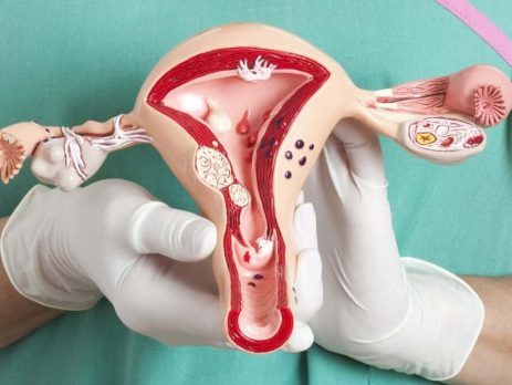 Эндометриоз: почему боль при месячных — это не норма и что с этим делать