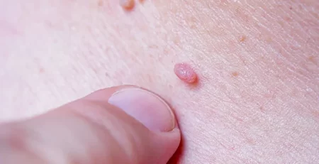 virus_papillomy_cheloveka