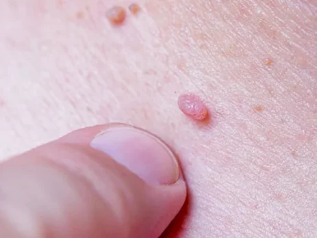 virus_papillomy_cheloveka
